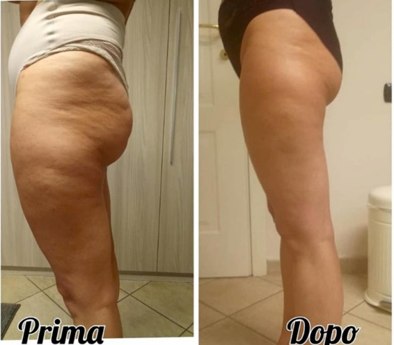 Premier Group Cosmetici , benefici prima e dopo, infraslimming